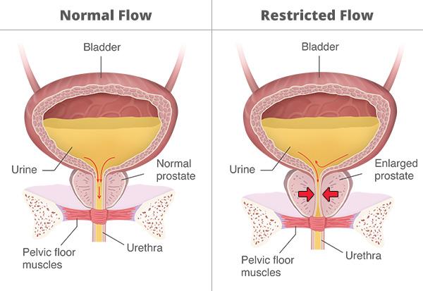 Understanding the Causes of Reduced Urine Flow and How to Address Them