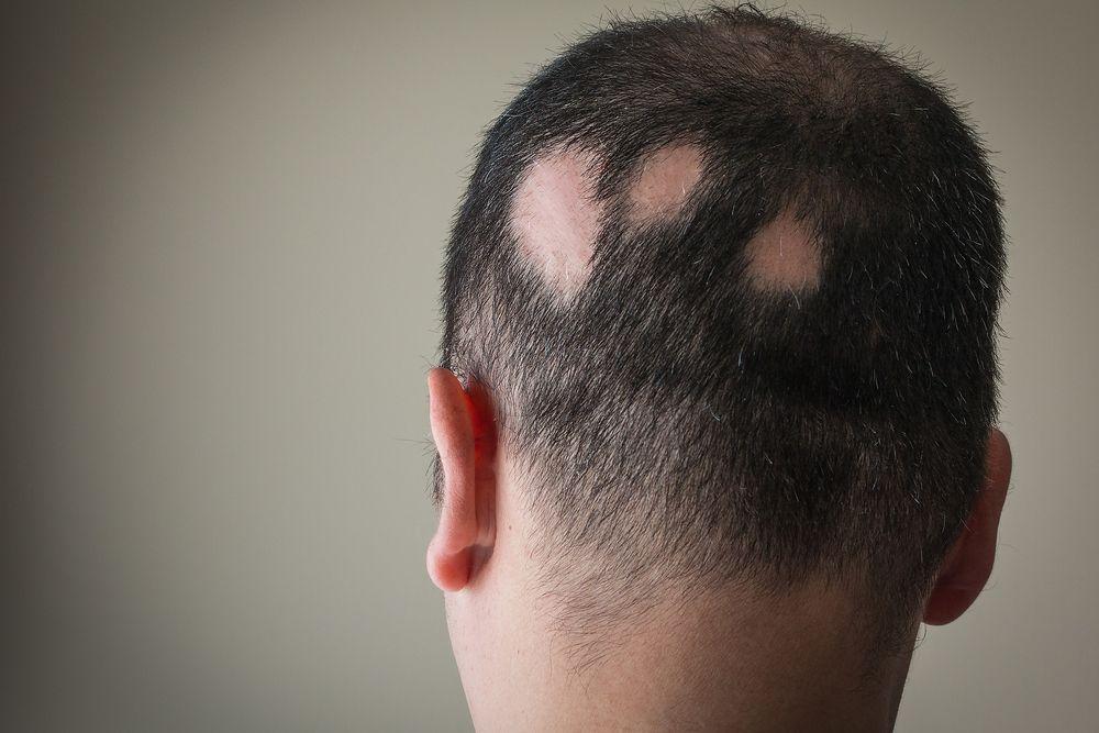 Understanding Common Causes of Hair Loss and How to Identify Them