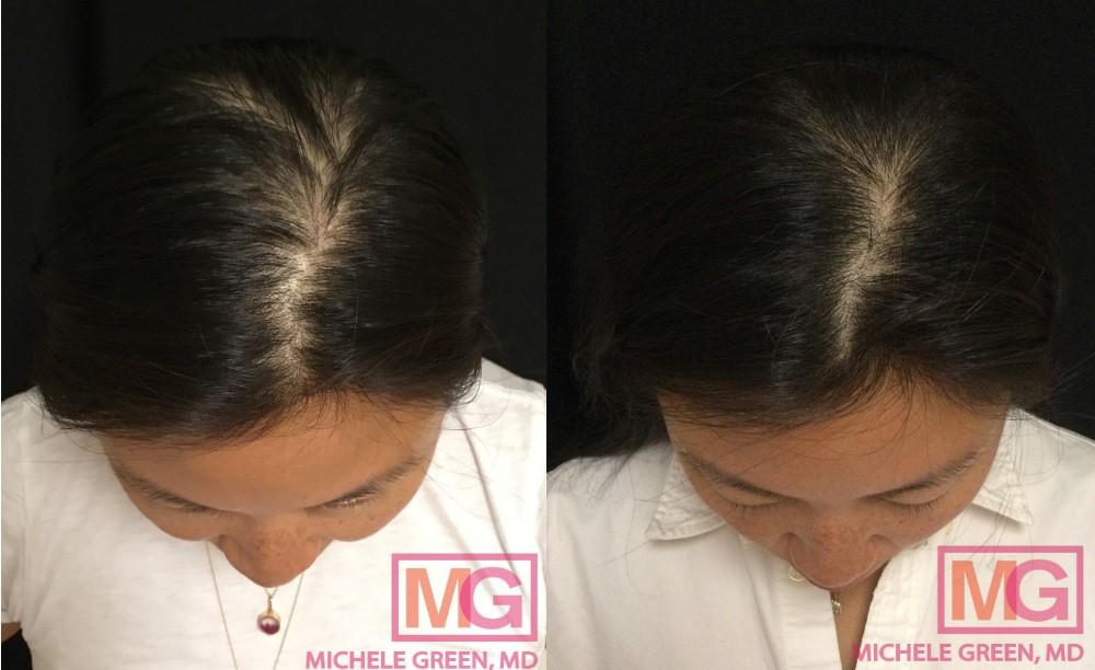 How Stress and Sleep Patterns Affect Your Hair Growth
