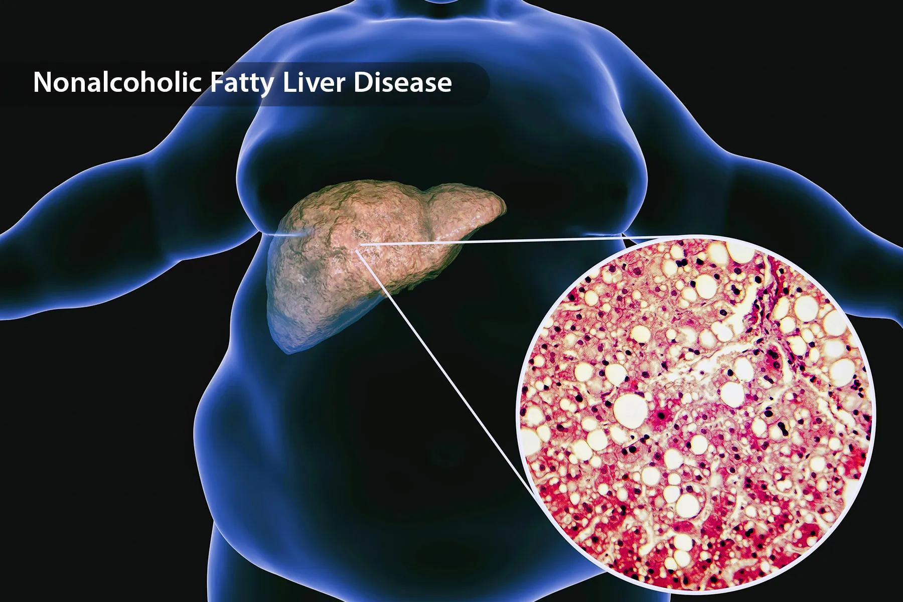 Expert Tips to Maximize Belly Fat Burn with Liver Support