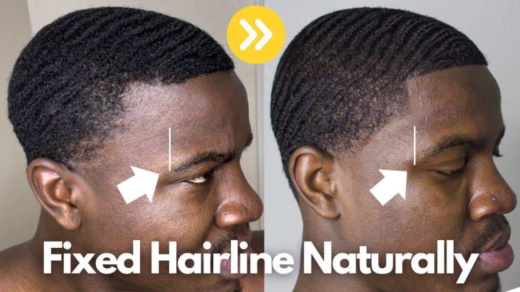 How to fight a receding hairline — add 3871 new strands in 60 days with fenugreek