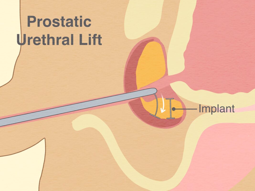 How to shrink prostate size in 10 days with pear