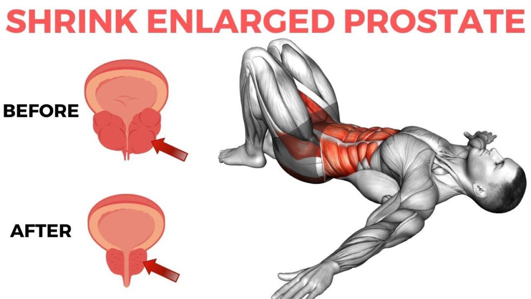 How to shrink prostate size in 28 days with red onions