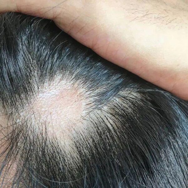 How to wake dormant follicles — add 3088 new strands in 6 months with pineapple