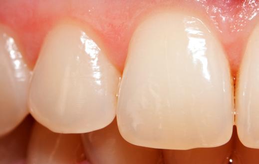 How to strengthen enamel by 6 shades in 28 days using tomato