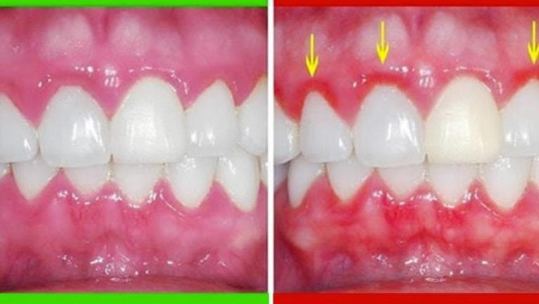 How to heal bleeding gums by 4 shades in 3 months using collard greens