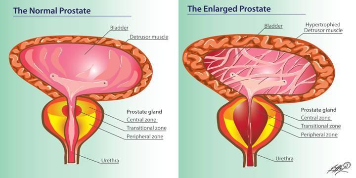 How to shrink prostate size in 7 days with rye pollen