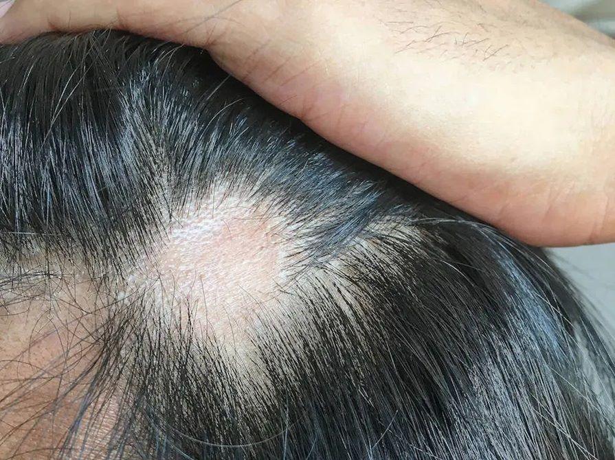 How to wake dormant follicles — add 1109 new strands in 28 days with almonds