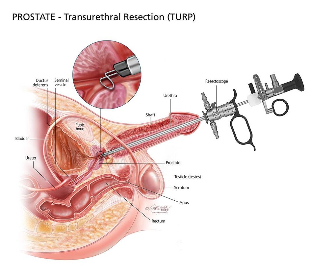 How to improve urinary flow in 7 days with lime