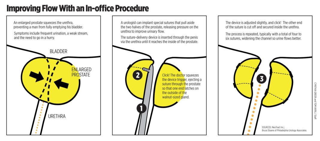 How to improve urinary flow in 14 days with apple