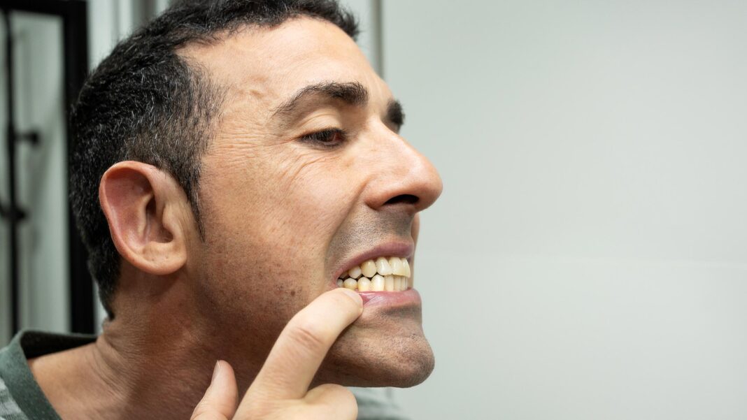 How to whiten teeth by 4 shades in 3 months using apple cider vinegar
