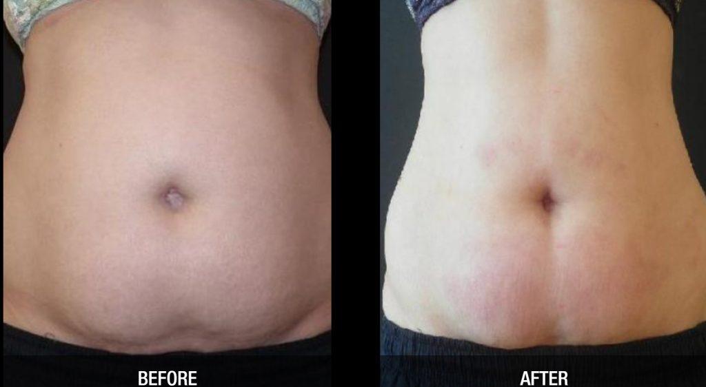 Monitoring Progress and Adjusting Your Regimen for Consistent Waist Reduction