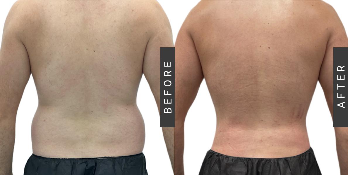 Monitoring Progress and Measuring Love Handle Reduction Accurately