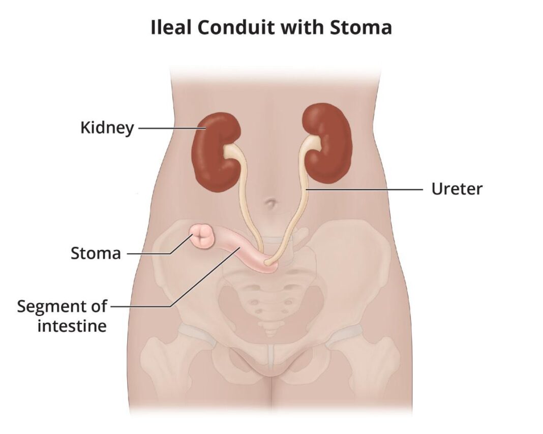 How to improve urinary flow in 6 months with lime