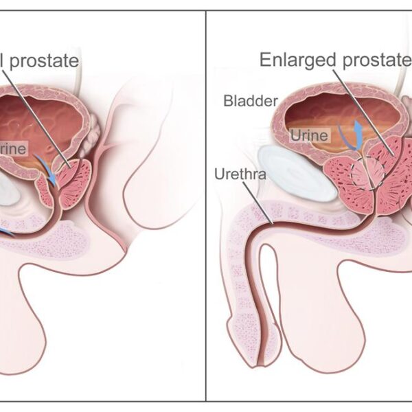 How to shrink prostate size in 21 days with chia seeds