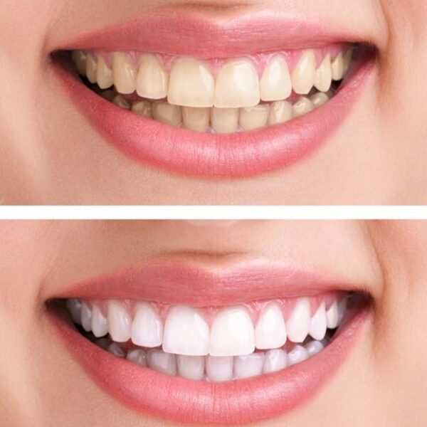 How to whiten teeth by 5 shades in 90 days using hibiscus