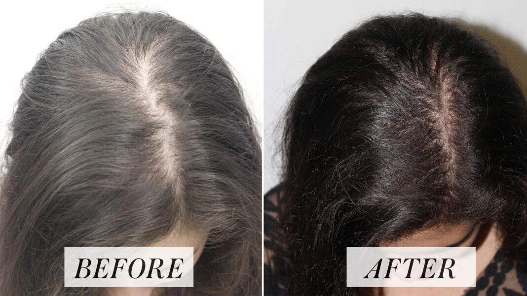 How to fight a receding hairline — add 3589 new strands in 3 months with artichoke