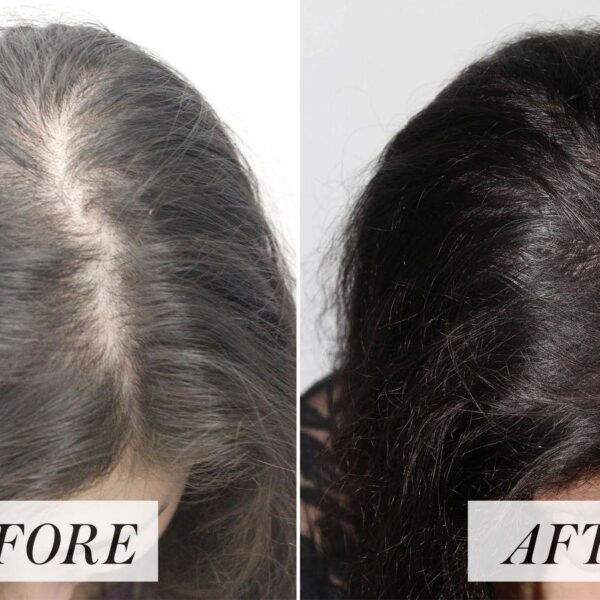 How to fight a receding hairline — add 3589 new strands in 3 months with artichoke