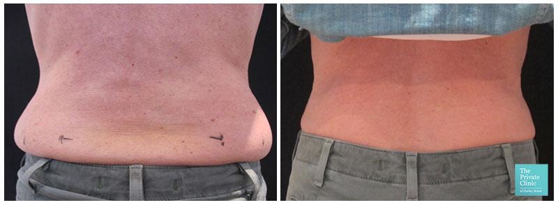 The Science Behind Love Handles and Fat Accumulation